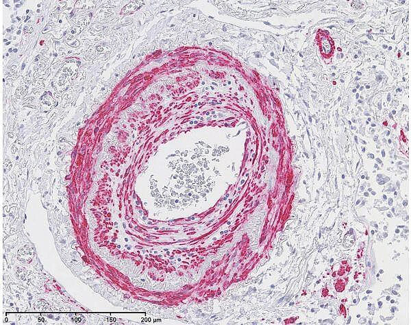 Human lung asma dako m0851 ab1500 area2 20x 1