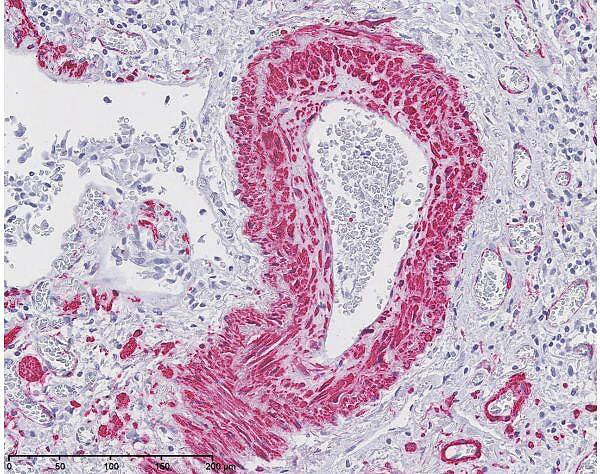 Human lung asma dako m0851 ab1500 area3 20x 1